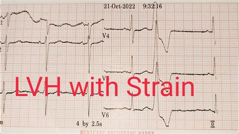 lvh strain
